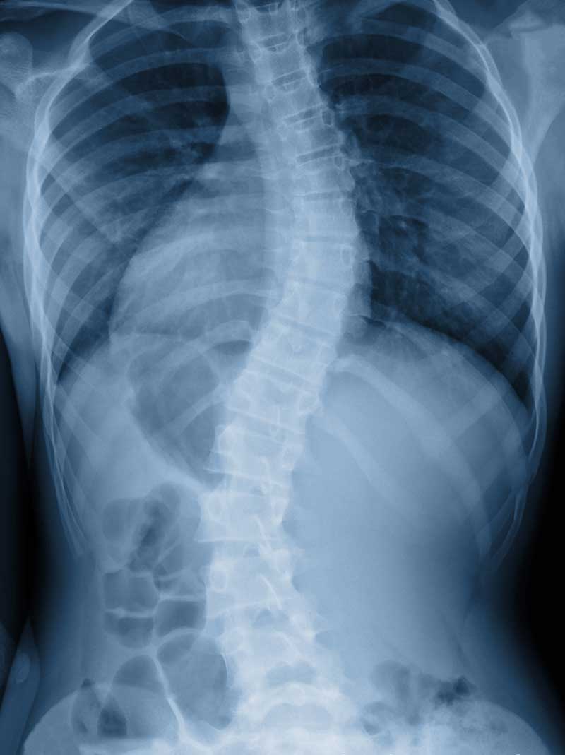 Scoliosis Treated in Tiffin